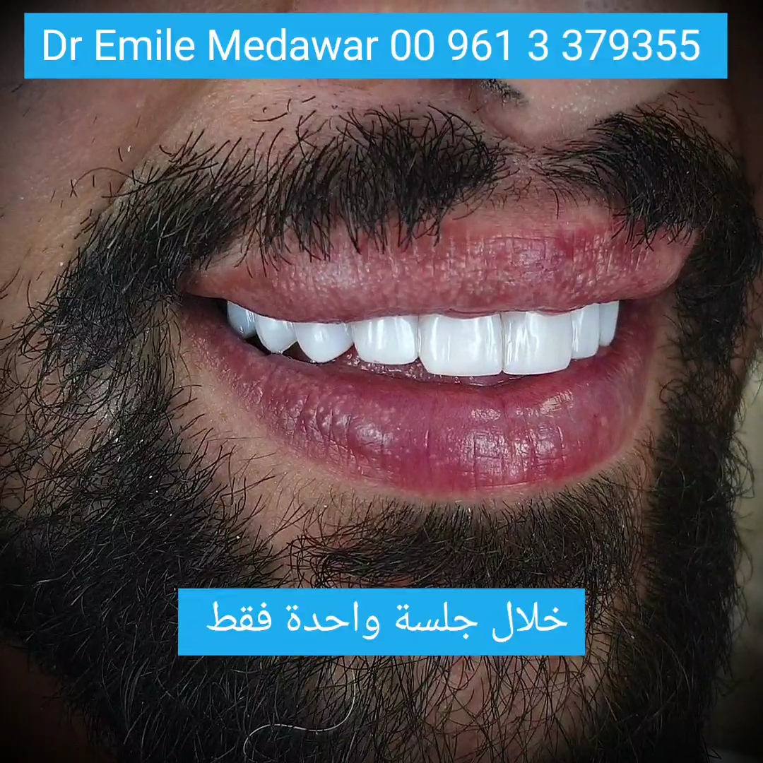 فينيرز لبنان ابتسامة هوليوود